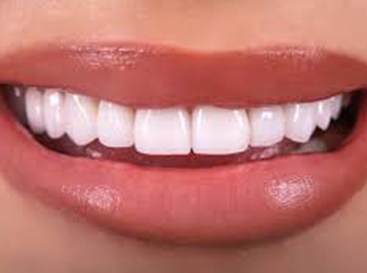 Dental Veneers