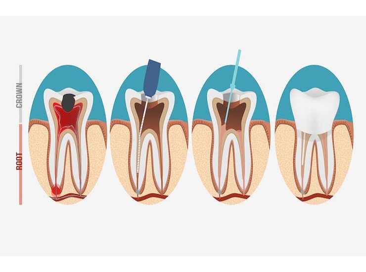 Root Canal Treatment
